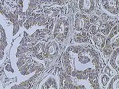 Immunohistochemistry of breast cancer (Infiltrating ductal carcinoma of the breast) assayed with anti HER-2 (ErbB2) antibody.