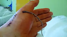 Hand with sutures and surgical drain