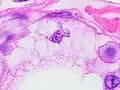 Lipid-laden histiocytes may mimic lipoblasts, but have lightly eosinophilic cytoplasm and a small normochromatic nuclei which are not hollowed out from the lipid vacuoles.