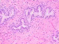 Histology of normal prostate, H&E stain, with benign features: Glands are rounded to irregularly branching, with an inner layer of epithelial cells surrounded by an outer layer of basal cells. They are surrounded by ample stroma.