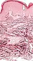 Histopathology of elastosis perforans serpiginosa: Degenerated elastic fibers and transepidermal perforating canals (arrow points at one of them)
