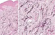 Histopathology: Accumulation of fragmented elastotic material within the papillary dermis and transcutaneous elimination of elastotic fibers.