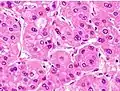 Moderately differentiated HCC.