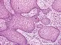 PEH, high magnification, with reactive-appearing squamous downgrowths with no significant cytologic atypia.
