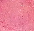 Histopathology of uterine fibroids typically show smooth muscle in a whorled (fascicular) pattern.