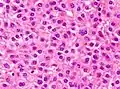 Well-differentiated  HCC
