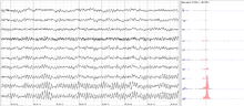  The sample of human EEG with prominent alpha-rhythm in occipital sites