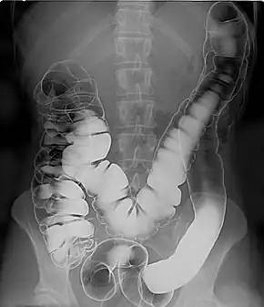 Double contrast barium enema, using positive and negative contrast