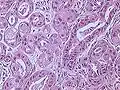 Invasive ductal carcinoma of the breast. H&E stain.