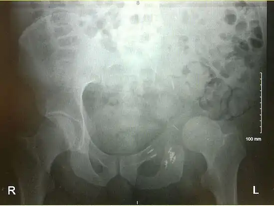 An x-ray of a limb-sparing hemipelvectomy on the left side of a male pelvis taken one month after surgery.
