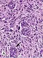 Invasive ductal carcinoma, with occasional entrapped normal ducts (arrow)