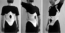 Modern brace for the treatment of a thoracic kyphosis. The brace is constructed using a CAD/CAM device.