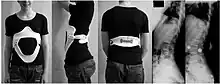 Modern brace for the treatment of lumbar or thoracolumbar kyphosis. The brace is constructed using a CAD/CAM device. Restoration of the lumbar lordosis is the main aim.