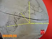 Wormian bones at lambdoid suture