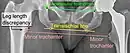 Leg length discrepancy after hip replacement is calculated as the vertical distance between the middle of the minor trochanters, using the acetabular tear drops or the transischial line as references for the horizontal plane. A discrepancy of up to 1&nbsp;cm is generally tolerated.