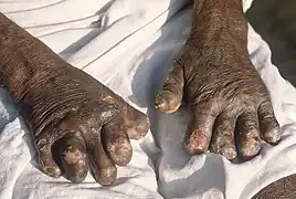 Hands deformed by leprosy, 2022