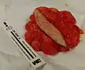 This lipoma was removed from the thigh of a 39-year-old male patient. It measured about 10&nbsp;cm in diameter at the time of removal. In the center is a section of skin that was removed with the lipoma.