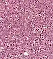 Undifferentiated nasopharyngeal carcinoma—high power