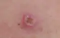 Melanoma, right posterior thigh