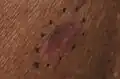 Melanoma, left mid-back marked for biopsy