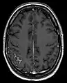 Meningeal carcinomatosis in a patient with breast cancer (contrast-enhanced axial T1-weighted MRI)