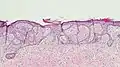 Fibroepitheliomatous pattern (anastomosing basaloid epithelial strands enclosing round islands of fibrous stroma)