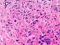 Gleason score 10 (5+5) with individual cells