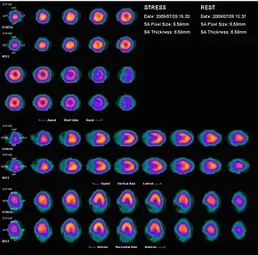 Nuclear medicine myocardial perfusion scan with thallium-201 for the rest images (bottom rows) and Tc-Sestamibi for the stress images (top rows). The nuclear medicine myocardial perfusion scan plays a pivotal role in the non-invasive evaluation of coronary artery disease. The study not only identifies patients with coronary artery disease; it also provides overall prognostic information or overall risk of adverse cardiac events for the patient.