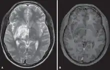 MRI scan of  Neuro-Behect brain