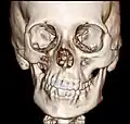 CT scan 3D bone reconstruction of a 17-year-old girl with Parry Romberg syndrome.