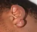 Pedunculated keloid that grows with a stalk, much like a mushroom