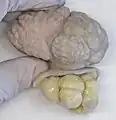 Pedunculated lipofibroma, gross pathology