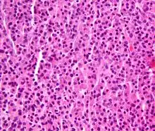 Plasmacytoma, H&E stain