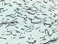 Angioinvasive pulmonary aspergillosis (closeup)