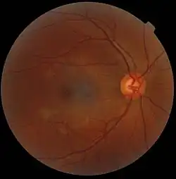 A fundus photograph showing the macula as a spot to the left. The optic disc is the area on the right where blood vessels converge. The grey, more diffuse spot in the centre is a shadow artifact.