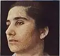Woman with extensive flat warts on her face