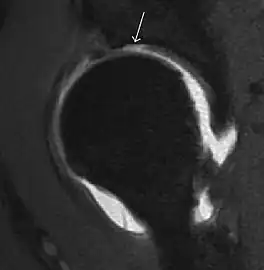 Sagittal T1 weighted image showing chondral lesion.
