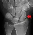 A subtle scaphoid fracture