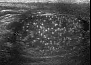 Fig. 25. Testicular microlithiasis. Multiple hyperechoic foci without acoustic shadow presenting as a starry sky appearance is seen in the testis.[citation needed]