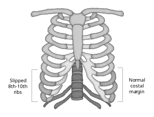 Slipping Rib Syndrome Example
