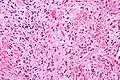 Solitary fibrous tumor - high magnification. H&E stain.