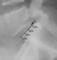 X-ray of measurement of spondylolisthesis at the lumbosacral joint, being 25% in this example