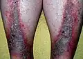 Stasis dermatitis (Gravitational eczema)