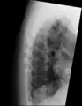 Confluent ossification of multiple contiguous vertebral bodies in diffuse idiopathic skeletal hyperostosis (DISH)