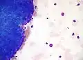 Thymoma. FNA specimen. Field stain.