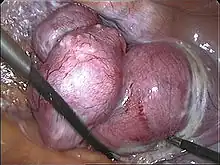 The uterus being removed in a laparoscopic vaginal hysterectomy