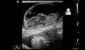 Ultrasound showing an incarcerated umbilical hernia