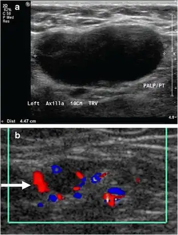 Medical ultrasonography of a soft tissue lump, showing signs of a suspected malignant lymph node:- Doppler ultrasonography that shows hyperaemic blood flow in the hilum and central cortex and/or abnormal (non-hilar cortical) blood flow- Increased focal cortical thickness greater than 3&nbsp;mm - Absence of the fatty hilum