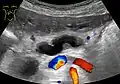 Ultrasonography of a dilated pancreatic duct (in this case 9mm) due to pancreatic cancer.