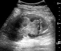 Renal ultrasonograph in renal trauma with laceration of the lower pole and subcapsular fluid collection below the kidney